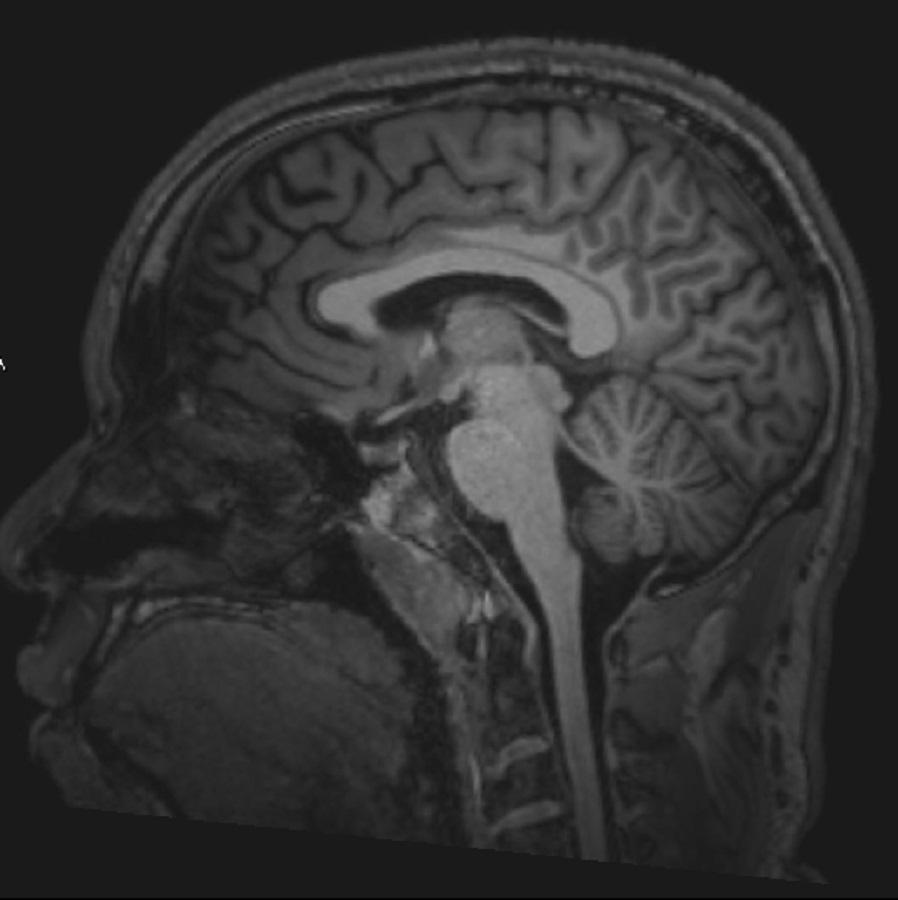 Стандартное МРТ-сканирование мозга (Сагиттальное) – слайд 3