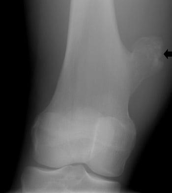 膝関節の骨軟骨腫