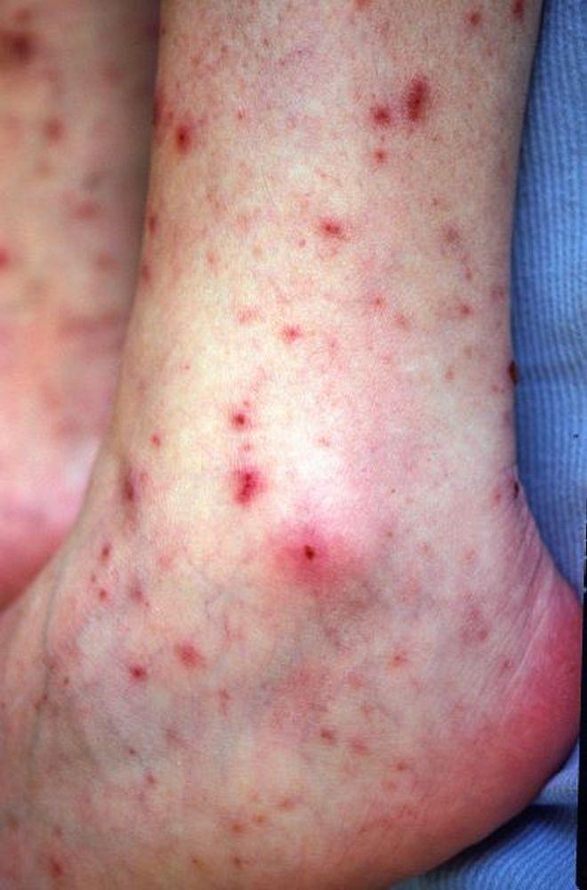 Chấm xuất huyết thứ phát sau nhiễm khuẩn huyết do Meningococcus (bàn chân)
