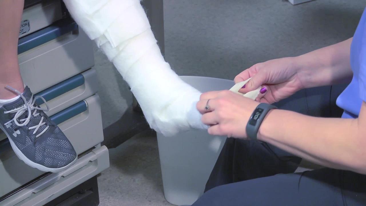 Наложение укороченной гипсовой повязки на ногу