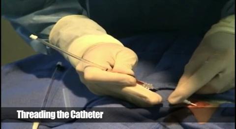 Inserção de catéter arterial na artéria radial