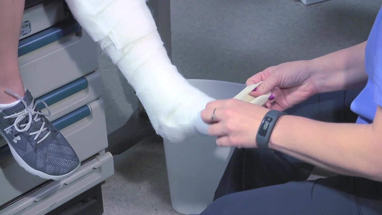 Cómo aplicar un yeso corto para la pierna