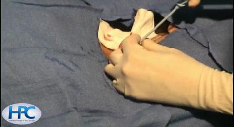 Perkutane Kanülierung der Vena jugularis interna unter Ultraschallkontrolle