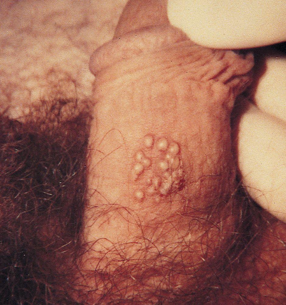 Herpes genital no pênis
