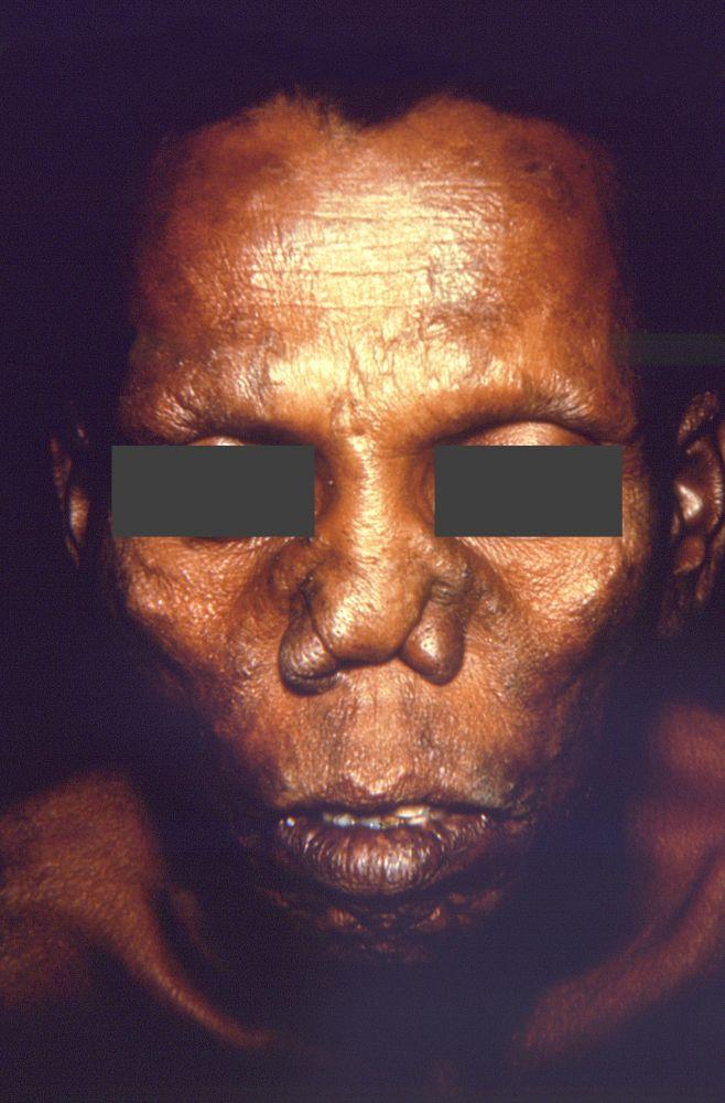 Schwerwiegende Wirkungen von Lepra mit Befall der Nase