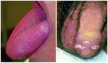 Mouth and Genital Sores in Behçet Disease