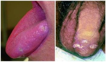 ベーチェット病による口および陰部の潰瘍
