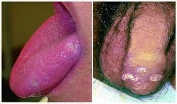 Ulcere orali e genitali nella malattia di Behçet