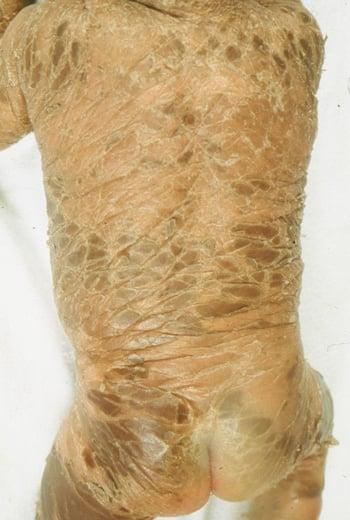 Severe Ichthyosis in a Child
