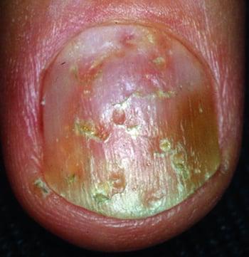 Psoriasis unguéal avec décoloration et dépressions des ongles