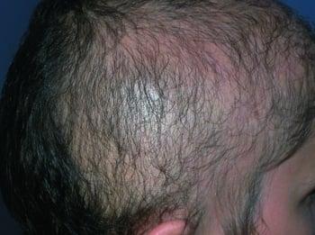 Mania de arrancar cabelos (tricotilomania)