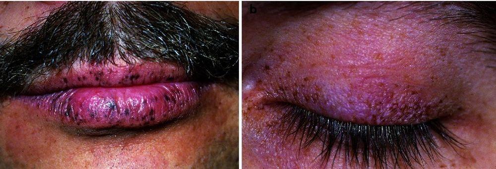 Manchas de color negro azulado en la piel y en los labios (síndrome de Peutz-Jeghers)