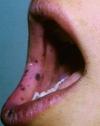 Pontos negro-azulados no interior da boca e nos lábios (síndrome de Peutz-Jeghers)