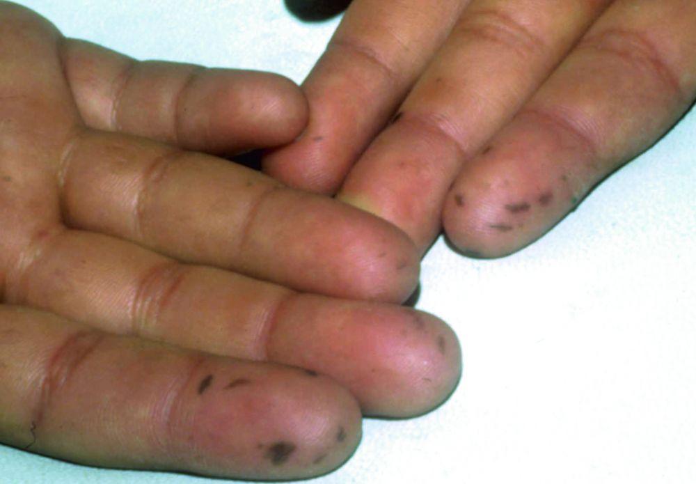 Manchas negro-azuladas en los dedos de las manos (síndrome de Peutz-Jeghers)