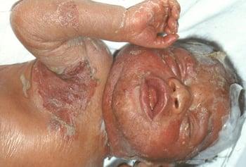 Sífilis del recién nacido (erupción)