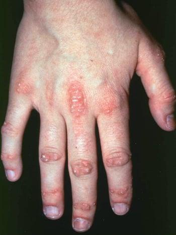 أعراض جلدية في سياق الإصابة بالتهاب الجلد والعضل