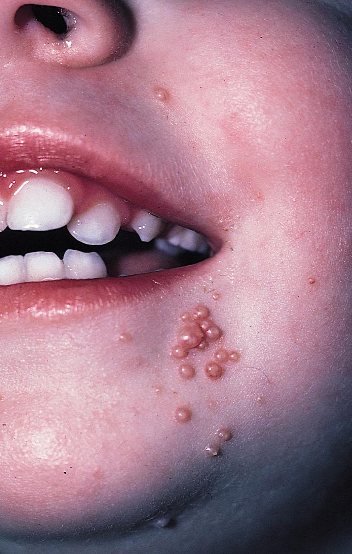 Mollusco contagioso sul viso di un bambino