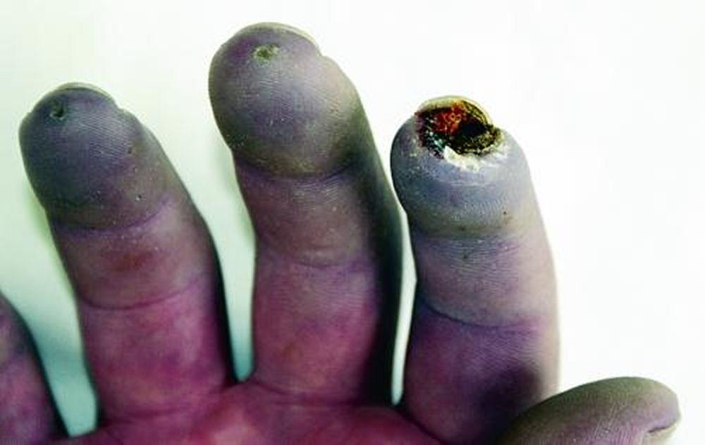 Síndrome de Raynaud com feridas nos dedos
