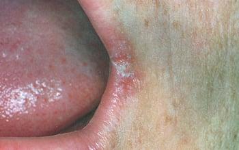 Angular Cheilitis