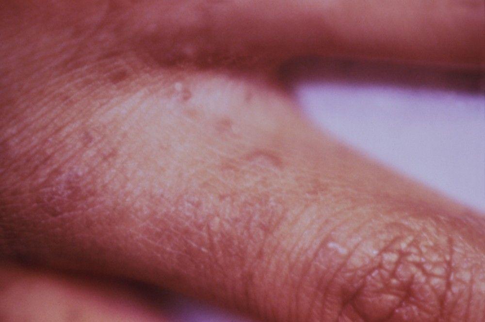 Scabies on the Fingers