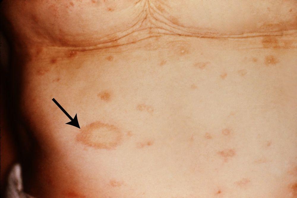 Pityriasis Rosea (Herald Patch)