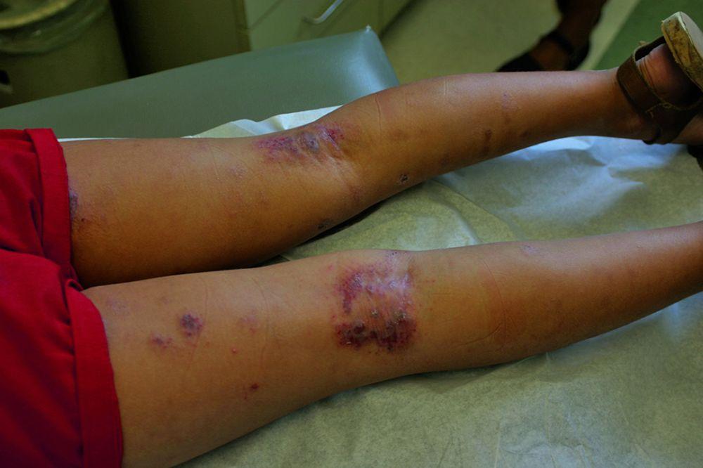 Dermatite atópica (atrás dos joelhos)