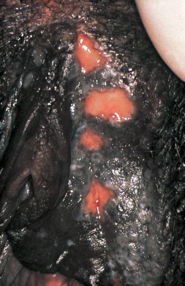 Herpes genitale con ulcere aperte