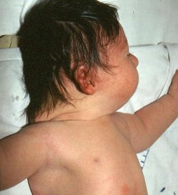 Down-Syndrom (überschüssige Haut im Nacken)