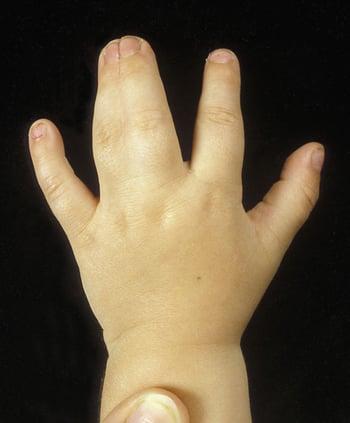 手の骨性合指症