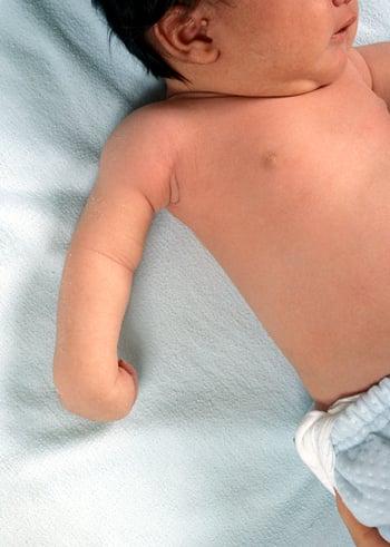 Paralisi di Erb in un neonato