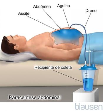 Paracentese abdominal
