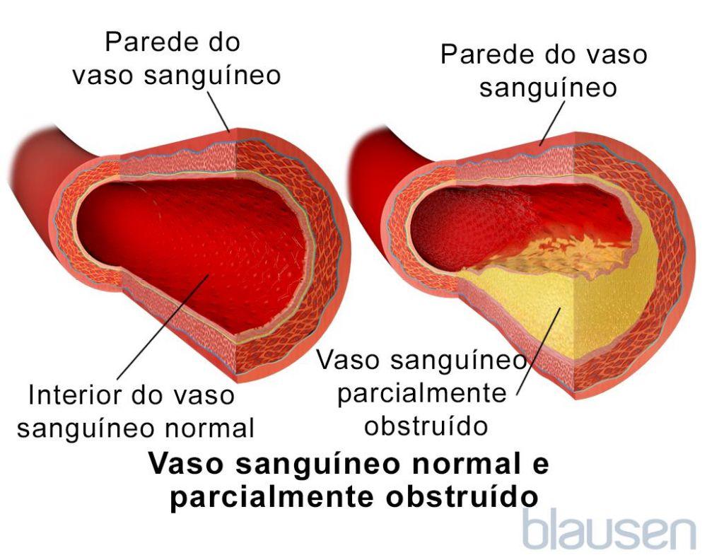 Vaso sanguíneo normal e vaso sanguíneo parcialmente obstruído