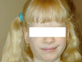 Альбинизм (кожные симптомы)