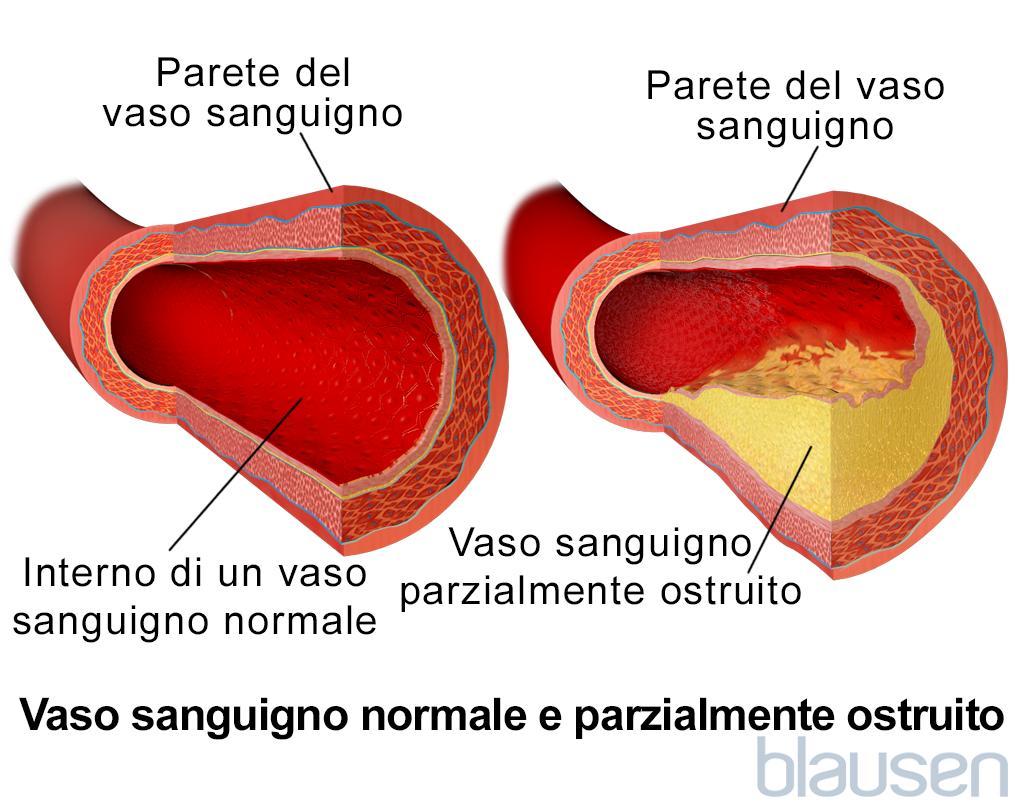 Vaso sanguigno normale e vaso sanguigno parzialmente ostruito