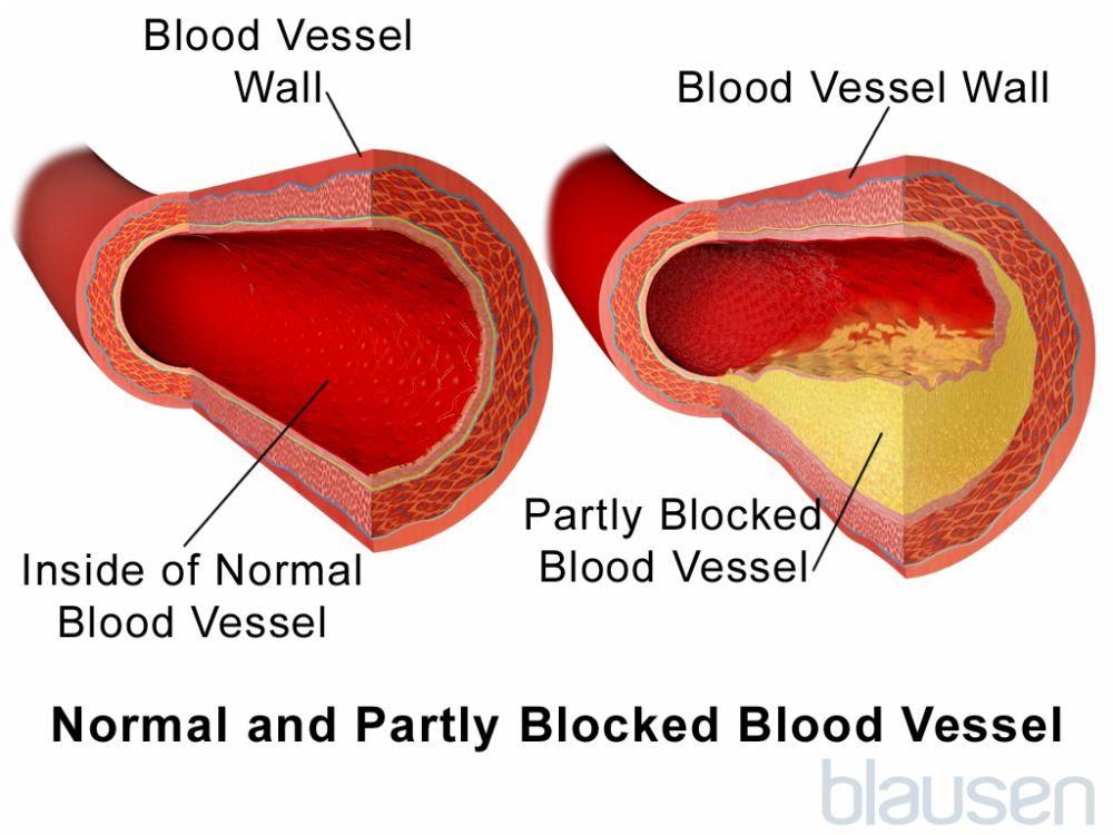 Здоровый кровеносный сосуд и частично закупоренный кровеносный сосуд