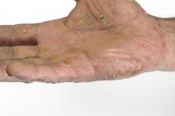 Palmoplantare Psoriasis an der Handfläche