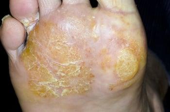 التهاب الجلد بخلل التعرق (القدم)