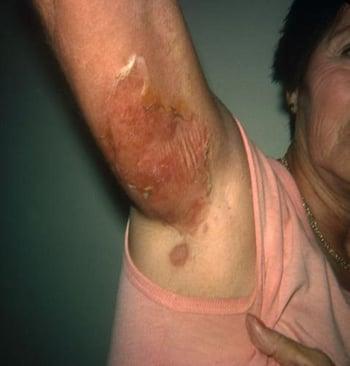 Erwachsene Person mit Staphylococcal Scalded Skin Syndrome (SSS-Syndrom)