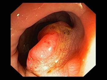 大腸がん（大腸内視鏡検査）