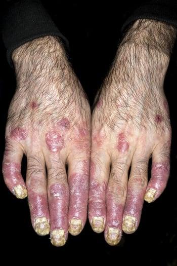 Artritis psoriásica de los dedos