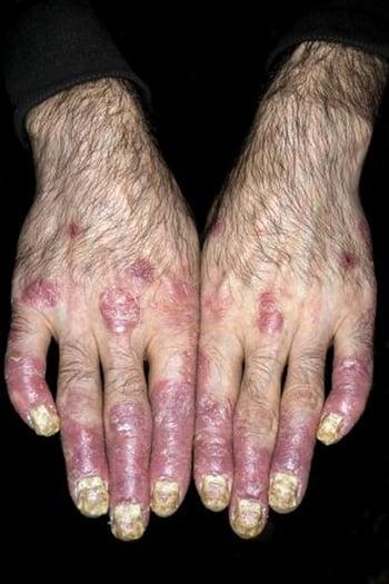 指の乾癬性関節炎