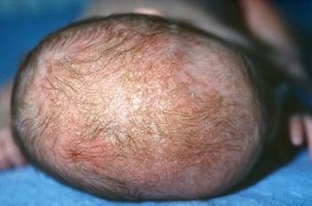 قِرفُ اللَّبَن "قِشرَةٌ مَثِّيَّةٌ عَلَى رَأسِ الوَليد" (التِهابُ الجِلدِ المَثِّيّ Seborrheic Dermatitis)