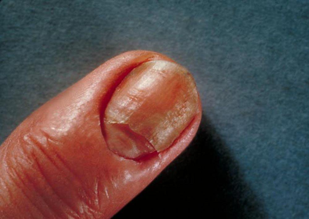 Infecção das unhas (candidíase)