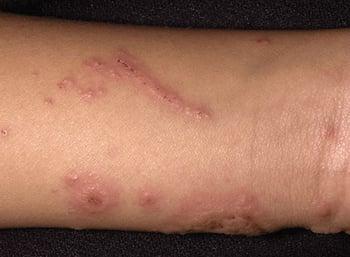 Dermatite de contato alérgica