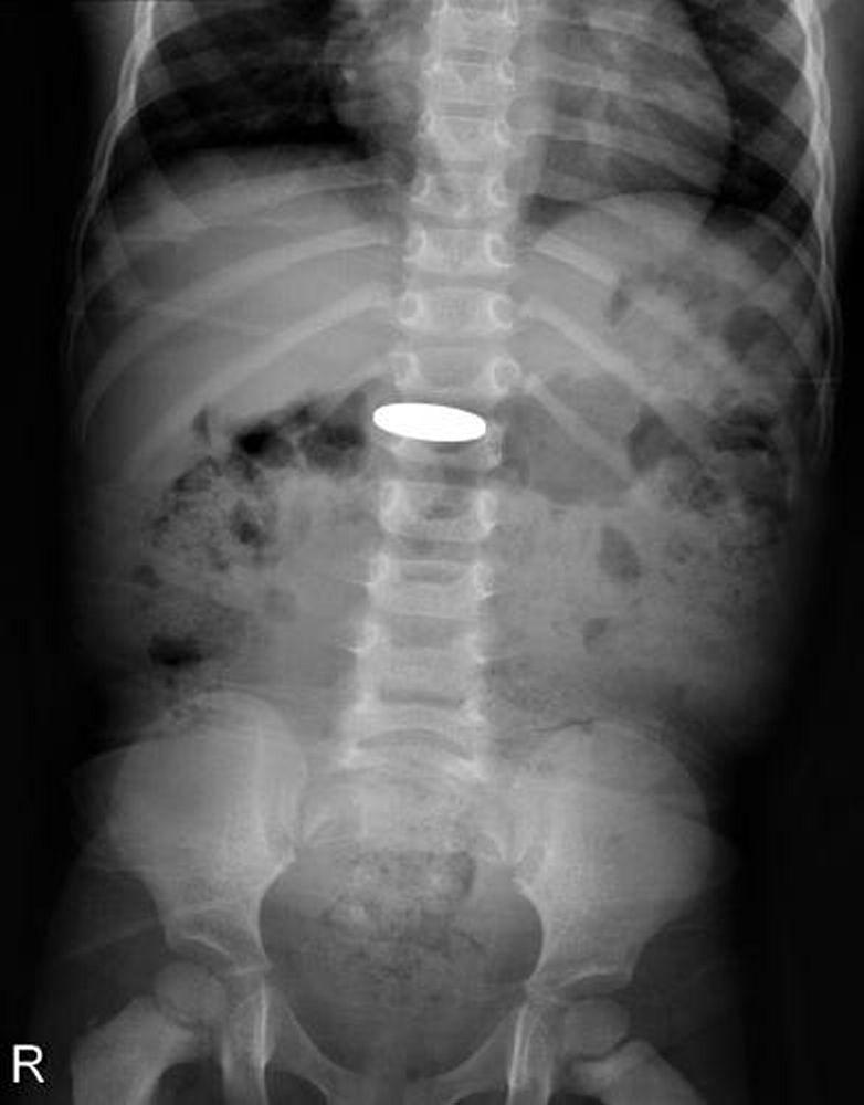 Инородное тело в пищеварительном тракте (рентгеновский снимок)