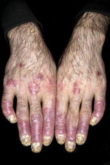 Artrite psoriasica delle dita