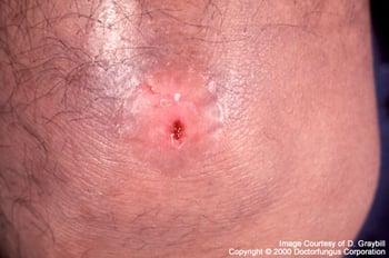 Coccidioidomicosi che causa una sola ulcera