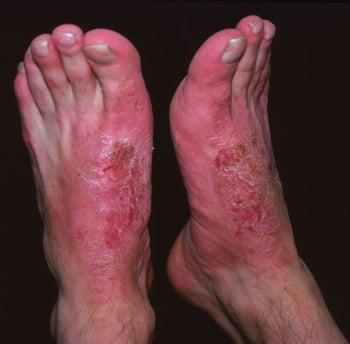 Dermatite da contatto (piede)