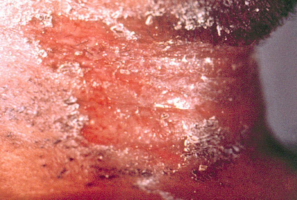 Difteria afetando a pele