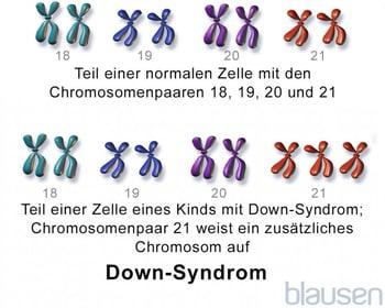 Down-Syndrom: Trisomie 21